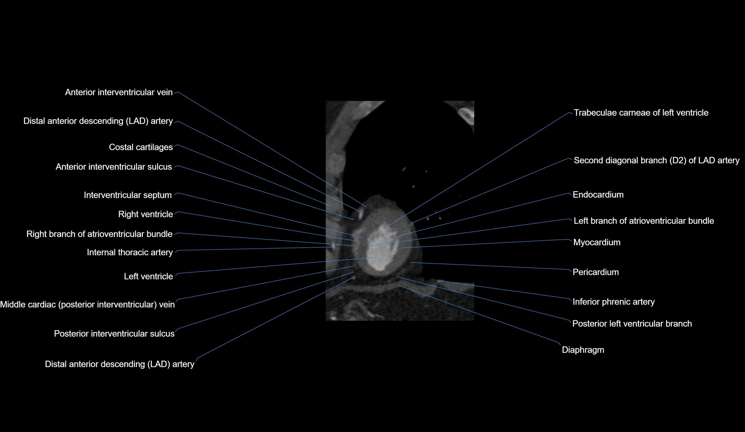 CT heart (coronary angiogram) short axis view  cross sectional anatomy labelled radiology image-00046.webp